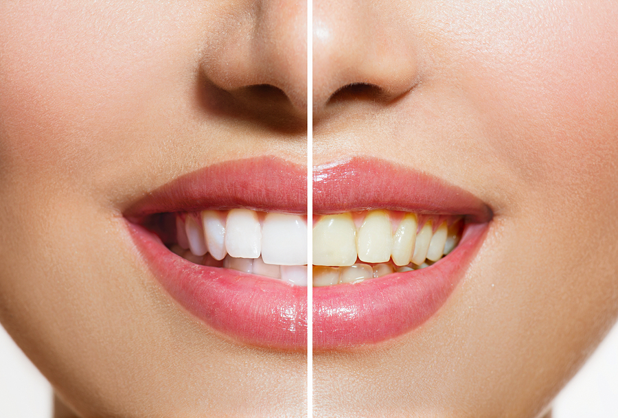 Photograph of woman's smile before and after seeing Cosmetic Dentist, Tampa, FL