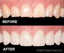 Before and After of Veneers
